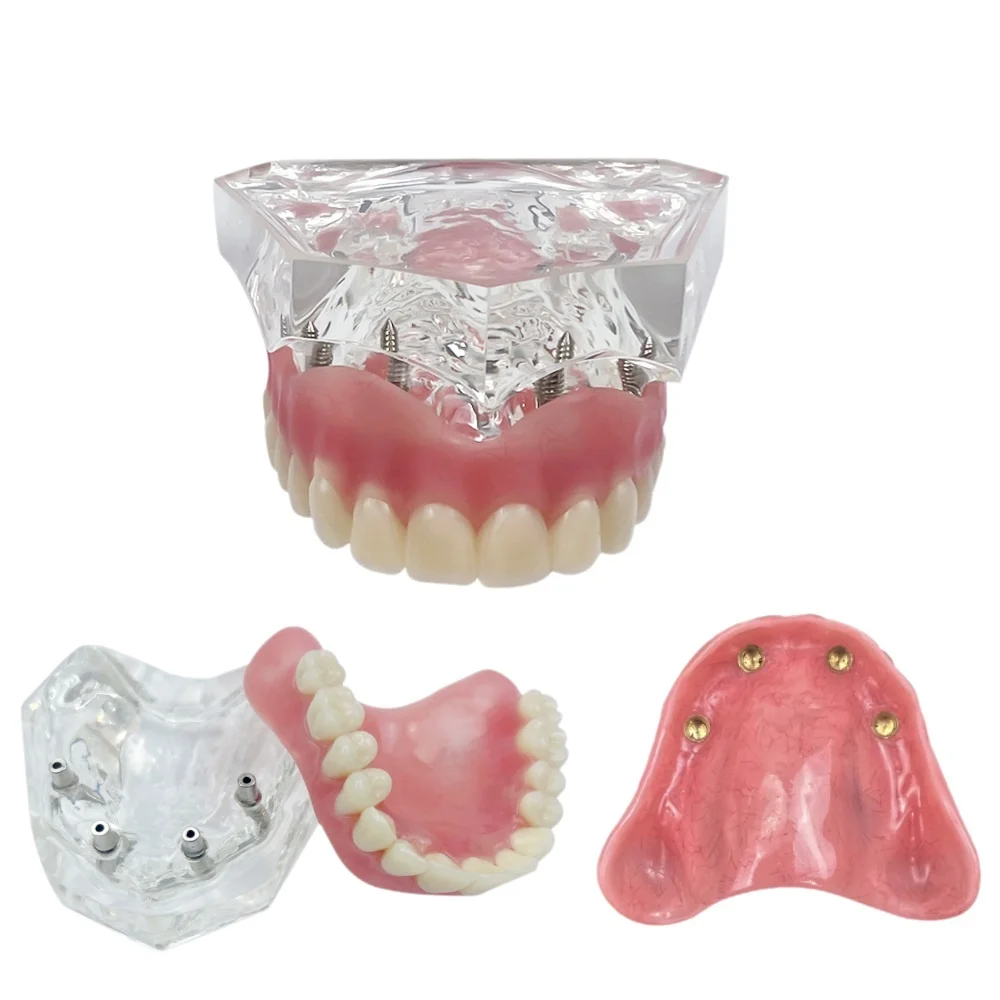 

Dental Teeth Model Transparent 4 Implants Overdenture Removable Bridge Lower Mandibular Lab Teaching M6003