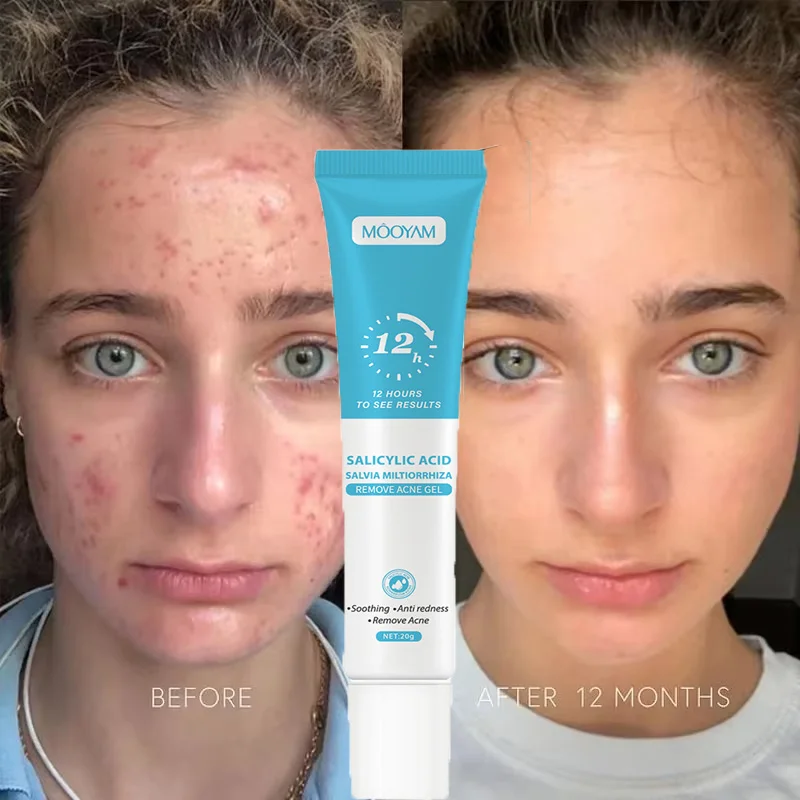 

Salicylic Acid Acne Removal Cream Anti-Acne Repair Redness Pimples Spots Deep Cleaning Pores Oil Control Moisturizing Skin Care