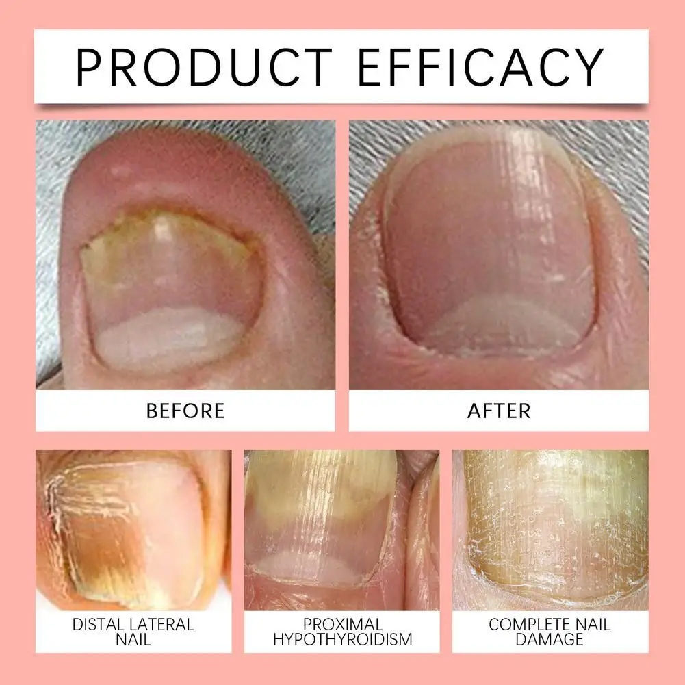 21 قطعة جديد أظافر الفطريات التصحيح مسمار إصلاح بقع مسمار نام تصحيح ملصق تغير لون الأظافر التالفة أداة العناية بالقدم