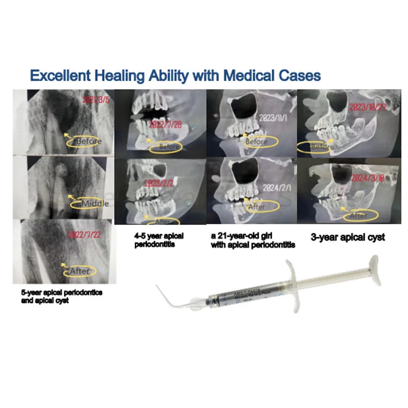 BEIKANG 2g/Tube Dental Oral ABIS Paste Abscess Remedy Antibacterial Gel Paste Agent Injectable Oral Clinic Consumable