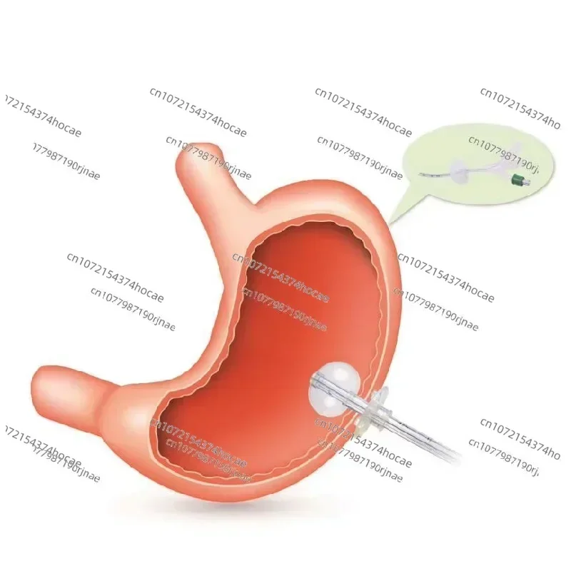 Medical fr6-fr24 stomach feeding tube mini button MIC-KEY gastrostomy kit pvc stomach tube，Five minimum orders