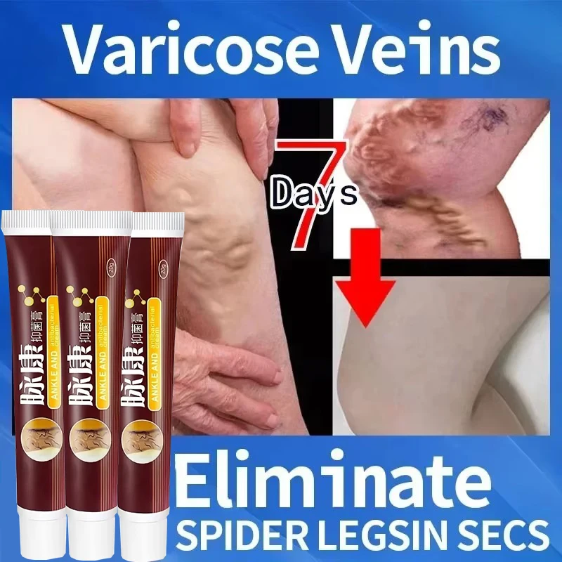 

Varicose Veins Products Eliminate Vasculitis Phlebitis to Relieve Spider Leg Pain Treatment Herbal cream