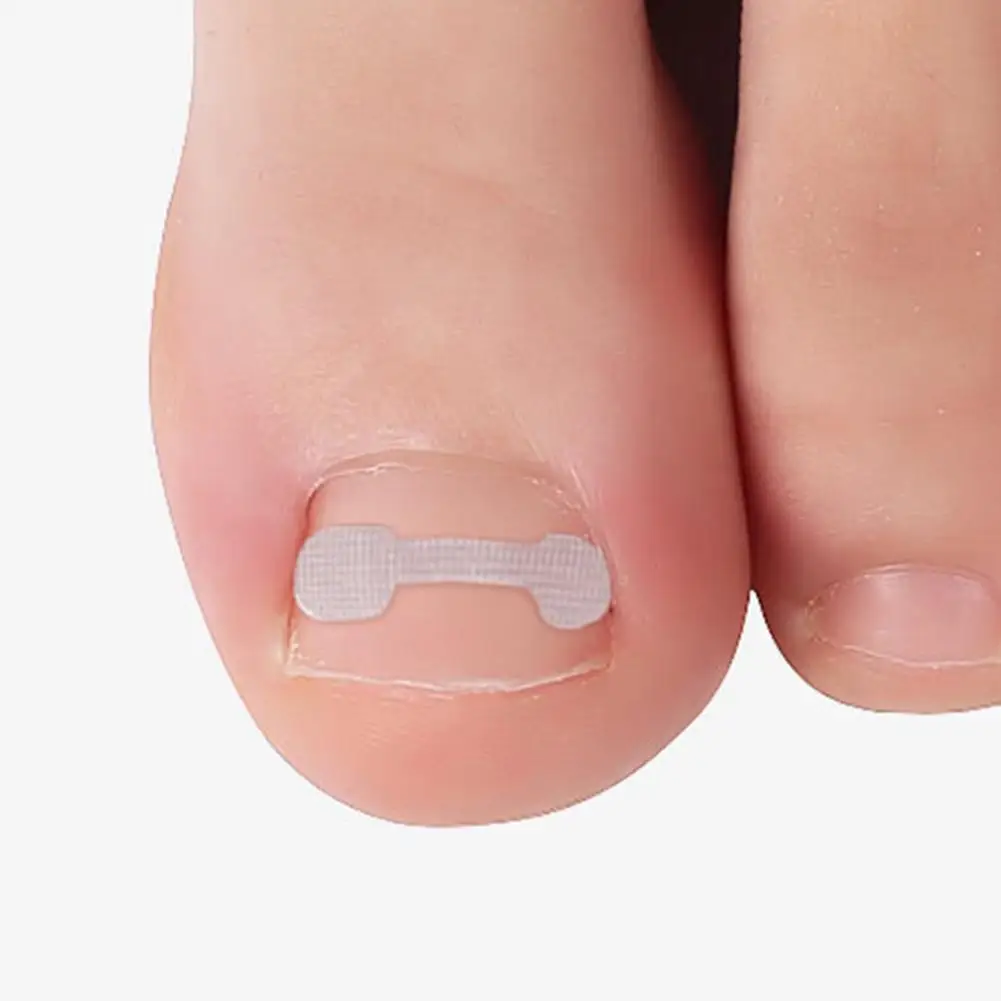 

Portable 10Pcs/Box Useful Impacted Toenail Correction Paste Soft Nail Corrector Quick Stick for Women