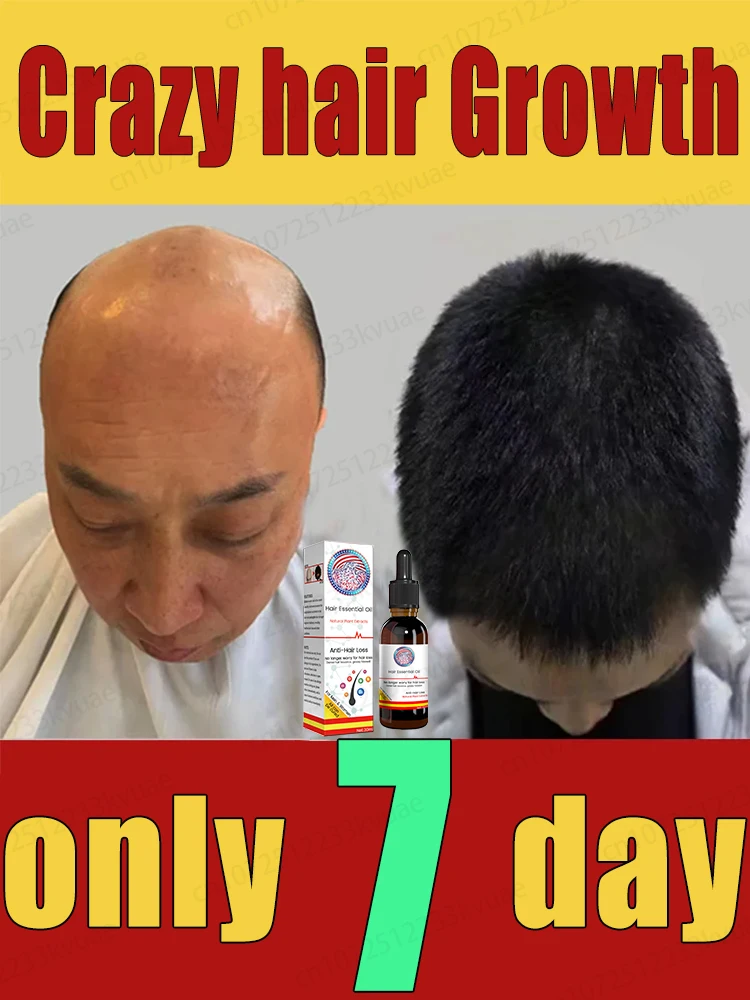 

Oil Hair Growth Products for Man Women Ginger Anti Hair Loss Fast Regrowth