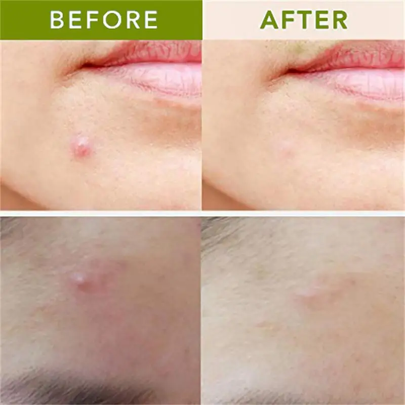 بقع بثرة العيوب الجبارة Microcrystal التصحيح بقعة قابلة للذوبان استهداف بقع للمكفوفين في مرحلة مبكرة من الصعب الوصول إليها ل #5