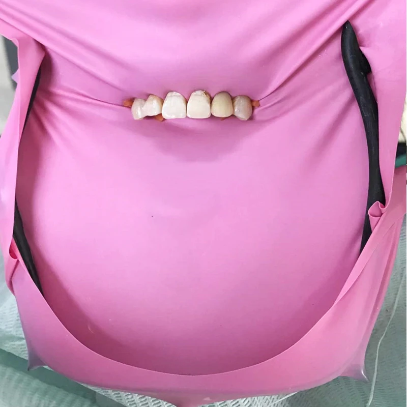 حامل إطار السد المطاطي للأسنان من ألياف الكربون المطاط يربك أداة عالية المرونة مختبر طب الأسنان فتاحة الفم الجراحية #3