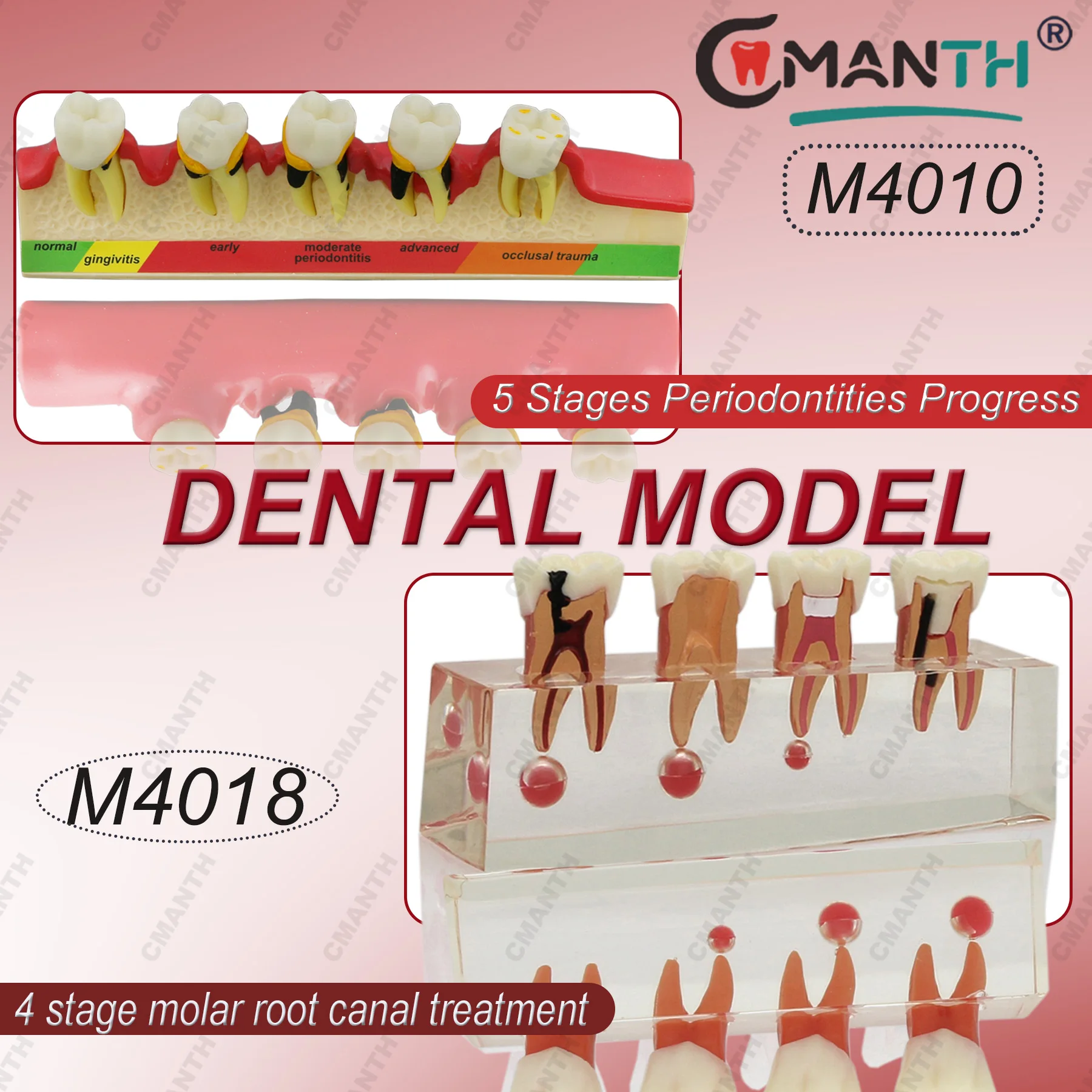 

Dental Teeth Model 4-Stage Endodontic Treatment 5 Stages Periodontal Disease Model For Dentist Patient Communication Demo