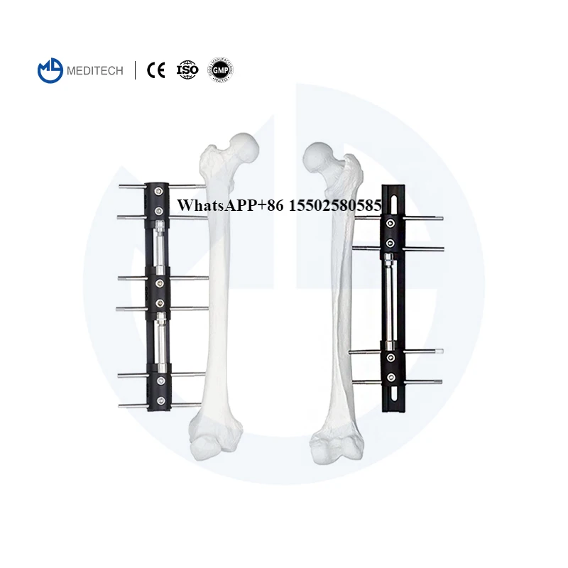 

External Fixation Bone Lengthening External Fixators for Fracture Surgery