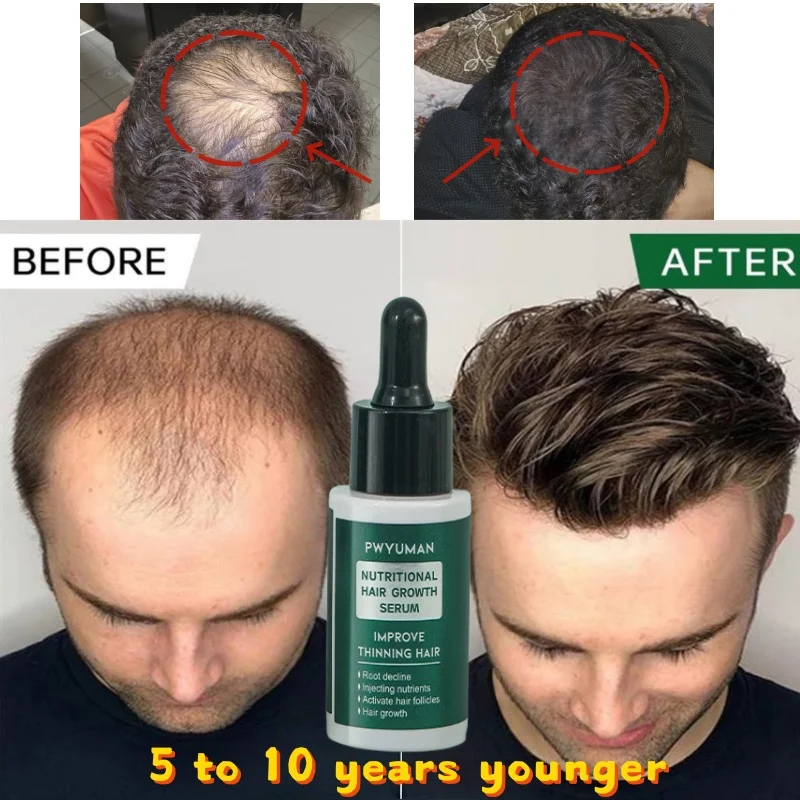 جوهر نمو الشعر السريع أفريقيا مجنون الجر الثعلبة مصل مكافحة كسر الشعر تخفيف القشرة وحكة فروة الرأس الشعر 30 مللي