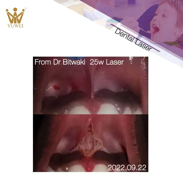Latest Technology Personal Care Device Soft Tissu Dental Laser Diode 980nm Price Whitening Machine
