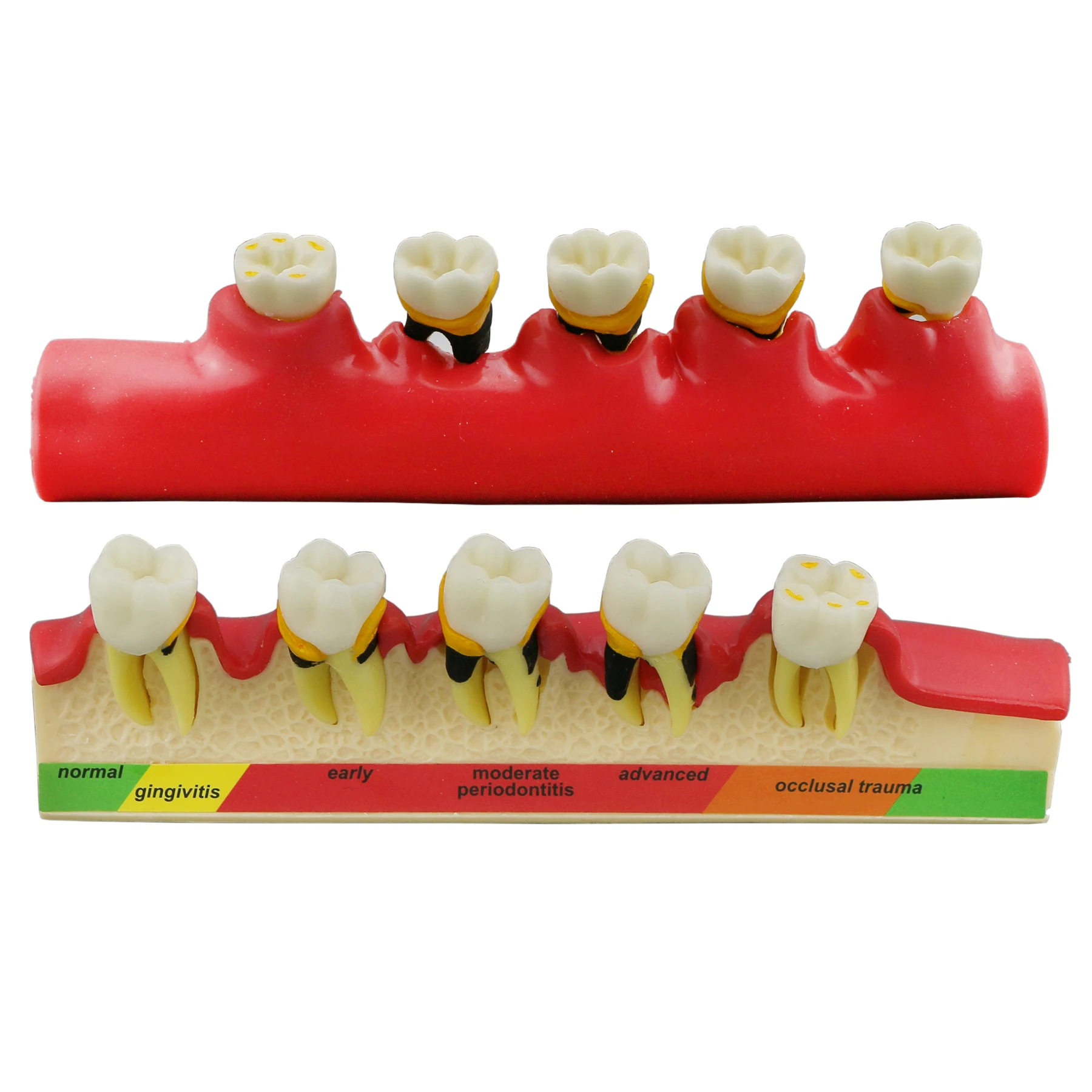 Dental Models Demonstrates Periodontal Disease Pathological 5 Stages Progress For Teaching Education Demo