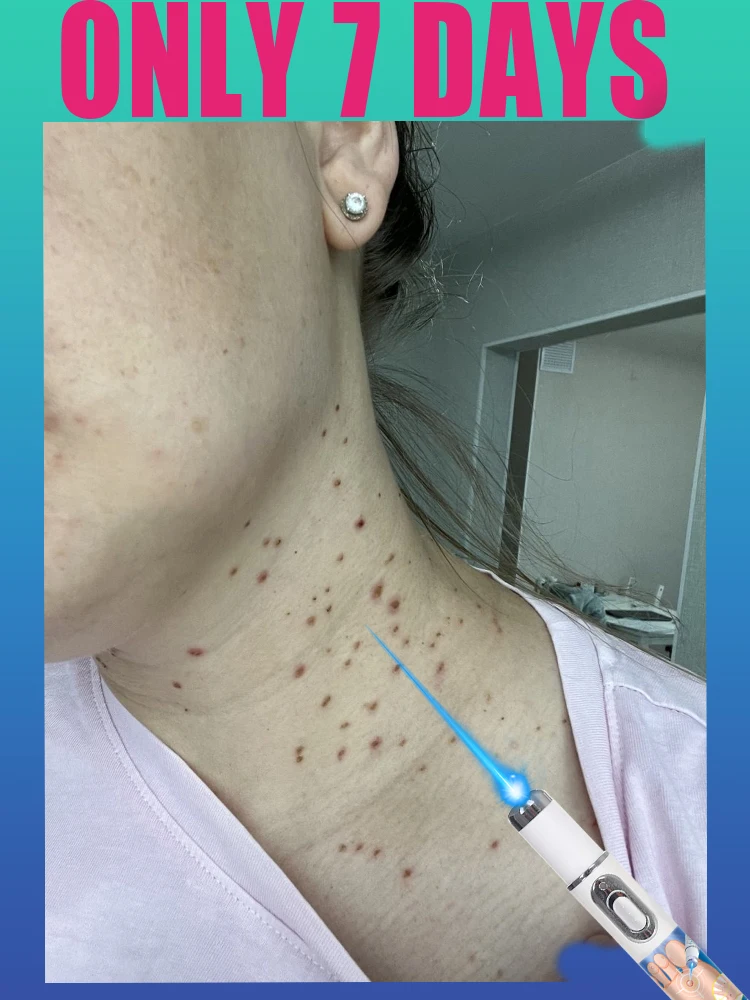 

Visible Results! Painless Wart get it off Pen - Easy Blue Light Therapy for Home Use