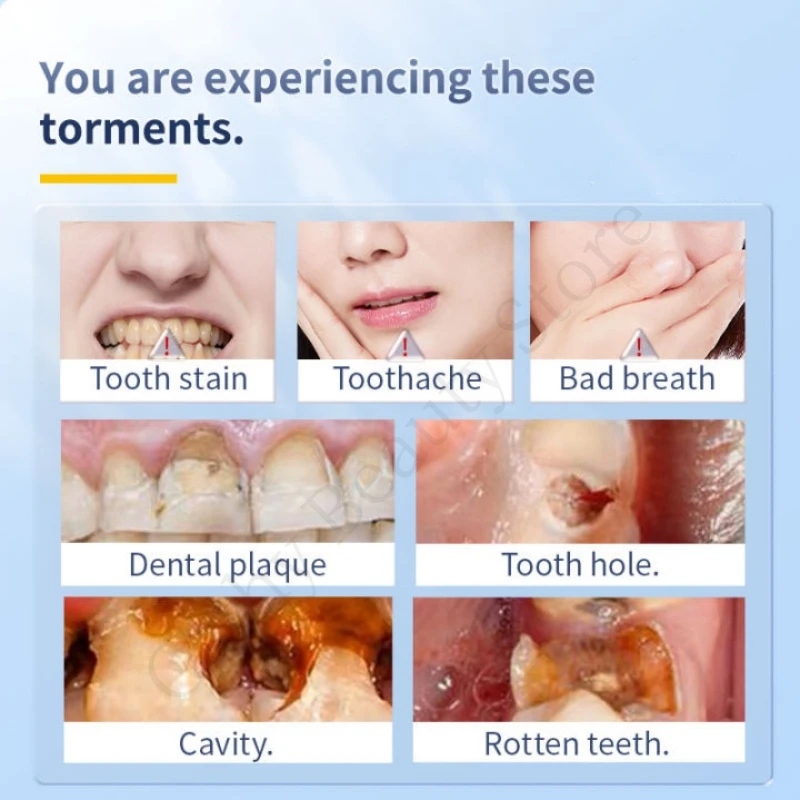 Dentifrice pour l'élimination du calcul dentaire, nettoyage des dents, blanchiment, élimination de la mauvaise haleine et de la plaque dentaire, prévention de la parodontite, soins de réparation des caries