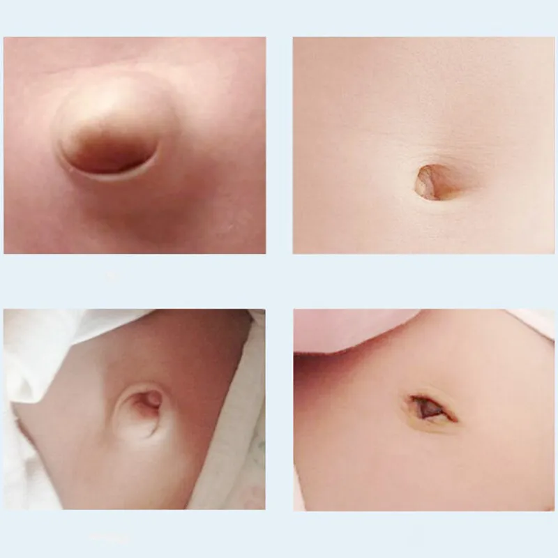 2 szt./pudełko Pas na przepuklinę pępkową dla niemowląt, oddychające pasy elastyczne z bawełny do leczenia przepukliny pępkowej