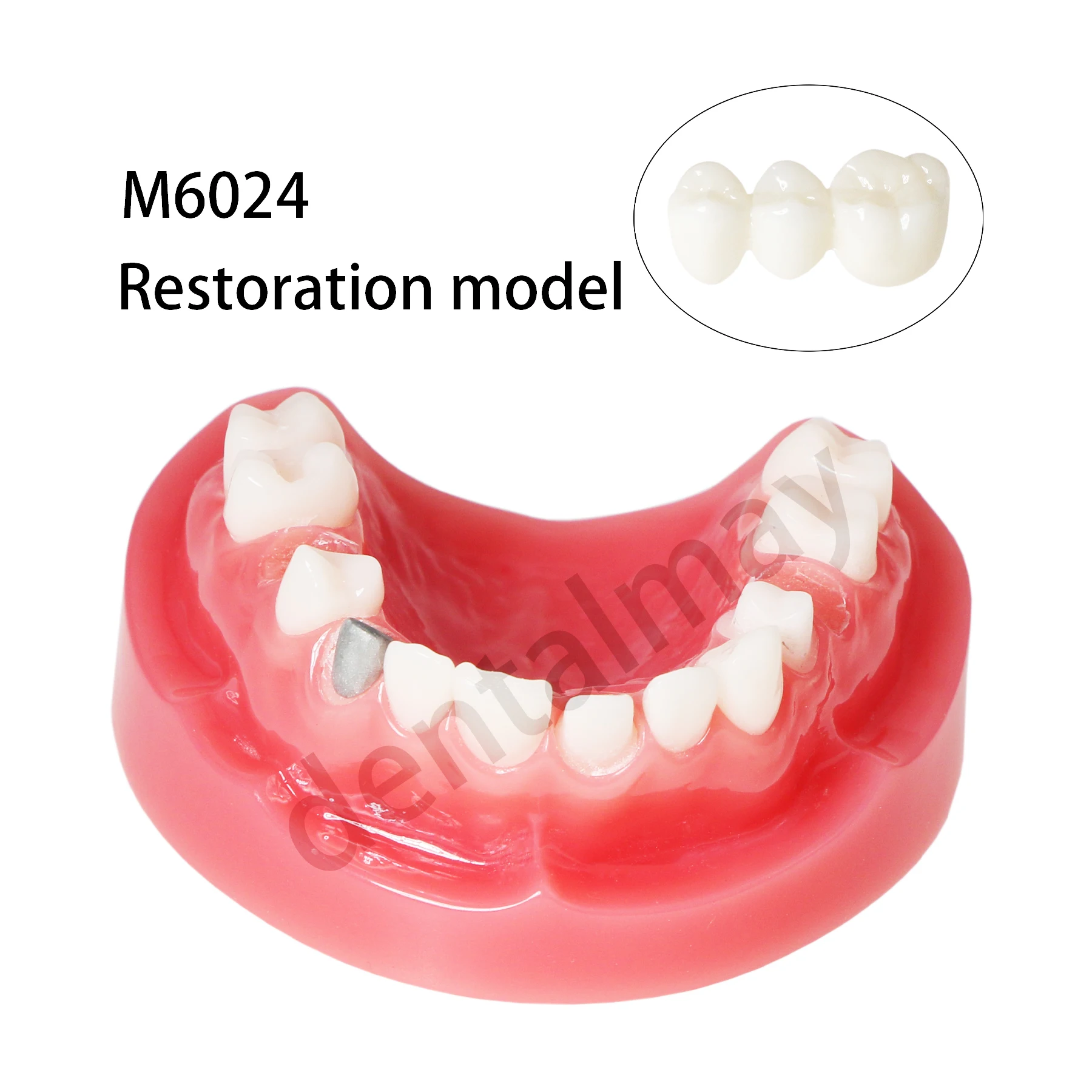 

Dental Teeth Model Implant Restoration Typodont Model with Post Core Bridge M6024