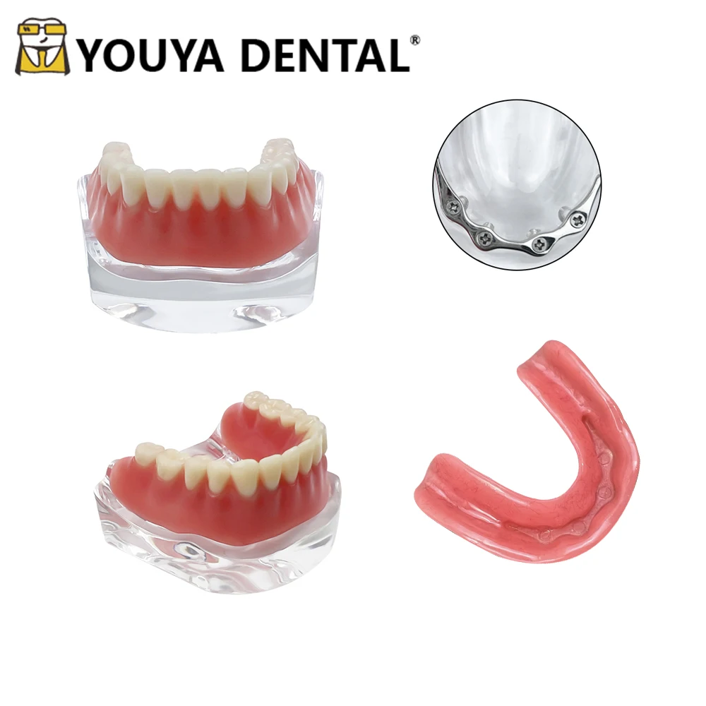 Dental Overdenture Implant Model Mandibular Implant Model with Silver Rod Type for Dental Technician Practice Training Studying
