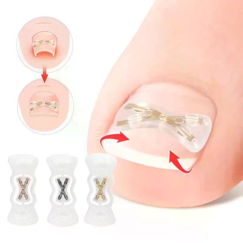 13/15/17MM Nail Correction Stickers Ingrown Toenail Corrector Patches Paronychia Treatment Recover Corrector Pedicure Tools
