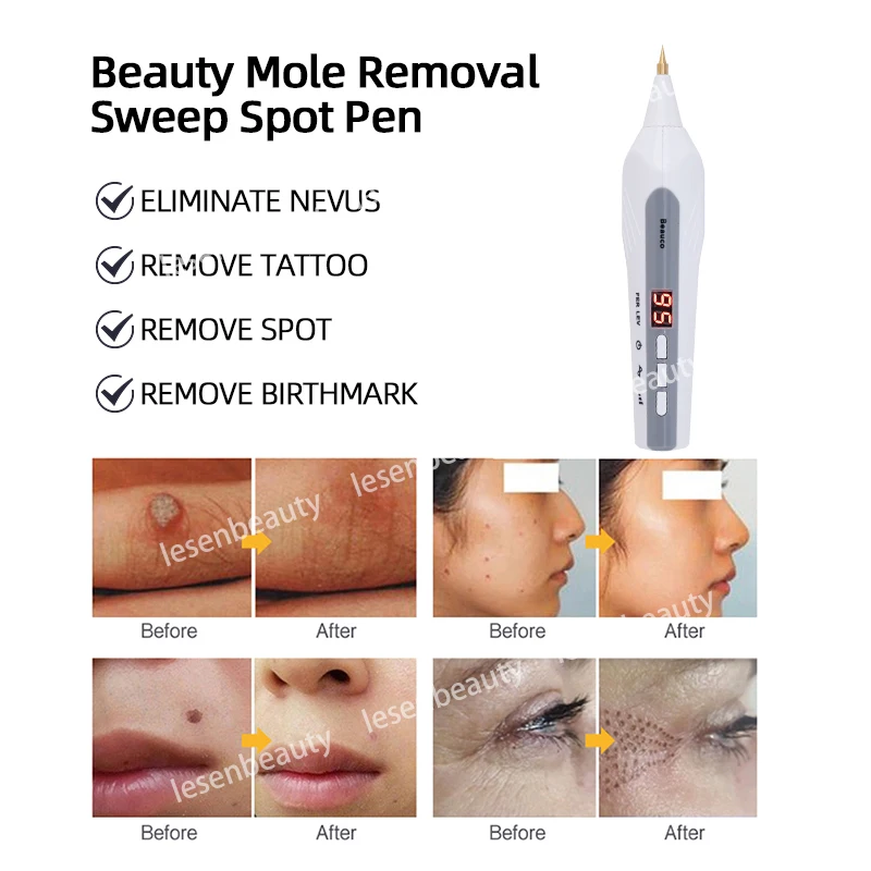 ปากกาพลาสม่า 9 ระดับปากกากําจัดจุด Tattoo Mole Removal Facial Freckle Dark Remover เครื่องมือกําจัดหูด Skin Tag Remover อุปกรณ์ US