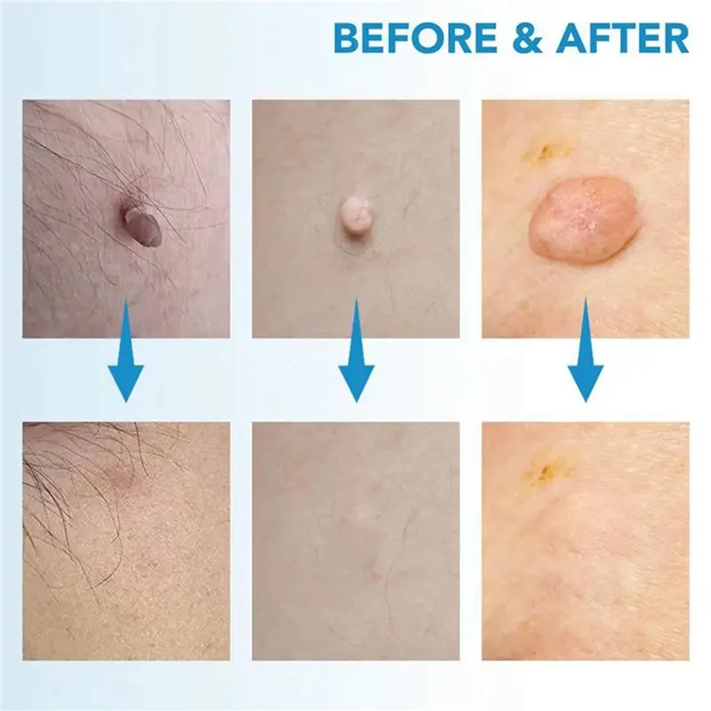 【¡Venta flash!】2X Kit de eliminación de etiquetas de piel pluma de eliminación de etiquetas de piel indolora dispositivo de eliminación de etiquetas de piel fácil elimina las etiquetas de la piel de 4Mm-9Mm