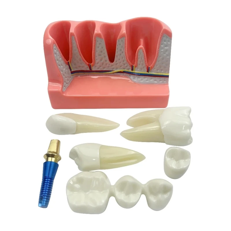 4 Times Dental Implant Teeth Model Analysis Crown Bridge Demonstration Removable Model Dentist Teaching Study Training  Model