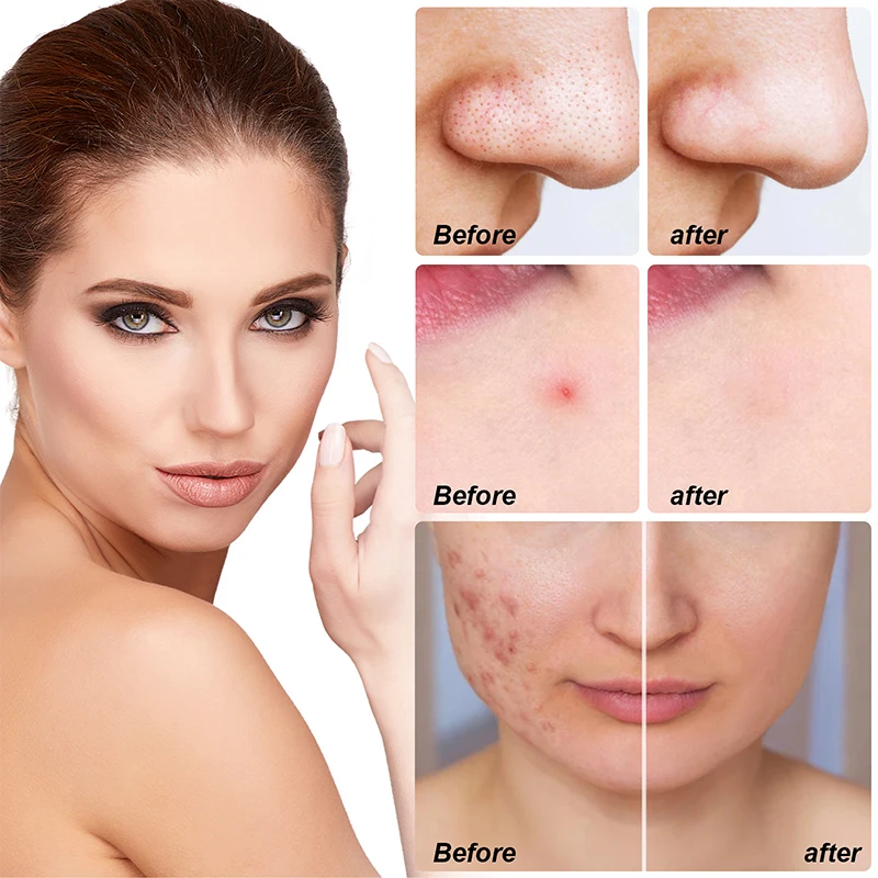 

5Pcs Large Hydrocolloid Patch Acne Removal Full Face Patches Protect Skin Face Cleaning For Nose Chin Forehead Cheek