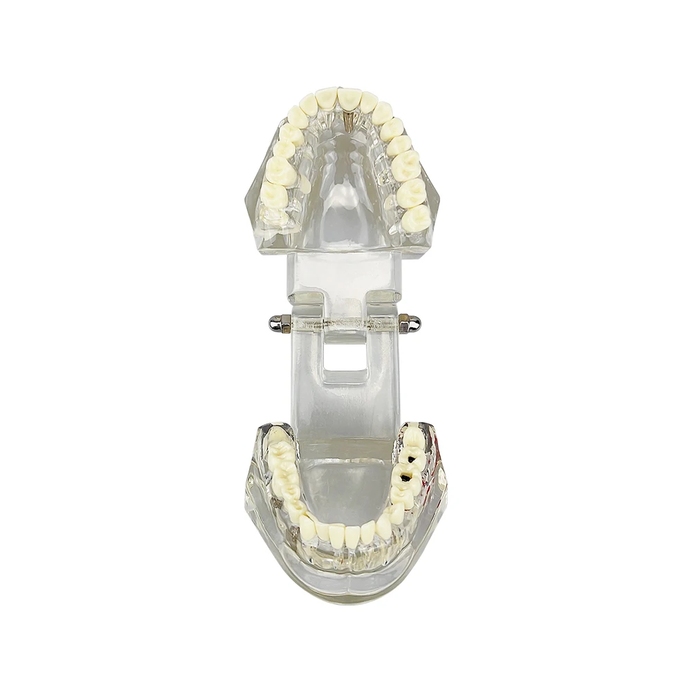 Dental Model Teeth Implant Restoration Bridge Teaching Study Medical Science Disease Analysis Model Dentist Dentistry Materials