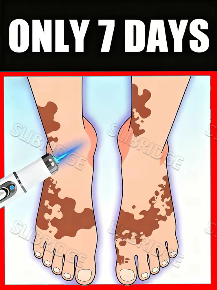 2025 hete verkoop, Vitiligo-behandelingsapparaat 2e verbeterde versieVitiligo-behandelingSnelle