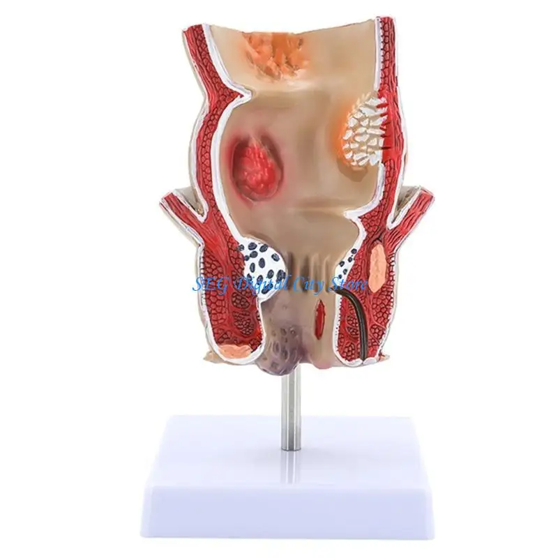 

U75B Human Anatomical Model Human Rectum Model Human Pathologies of Rectum Model Teaching Aid for Science Education