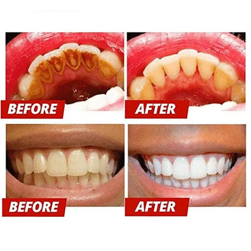 Creme dental tipo push para remover o tártaro, cárie dentária, creme dental mousse para limpeza profunda, branqueamento dos dentes, respiração