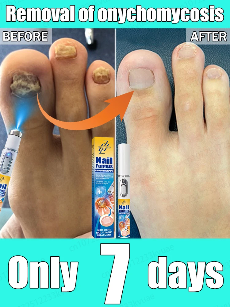 

Say goodbye to onychomycosis, scientific, safe, and no recurrence
