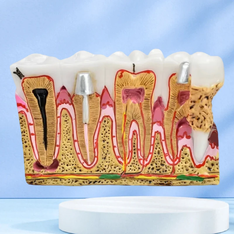 

Зубные кариесы, анатомия, комплексная патология, нерв для устного обучения, модель зубов