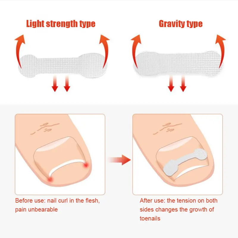 

10/20/40/50Pcs Ingrown Toe Nail Treatment Ingrown Toenail Correction Tool Elastic Patch Sticker Straightening Clip Pedicure Tool