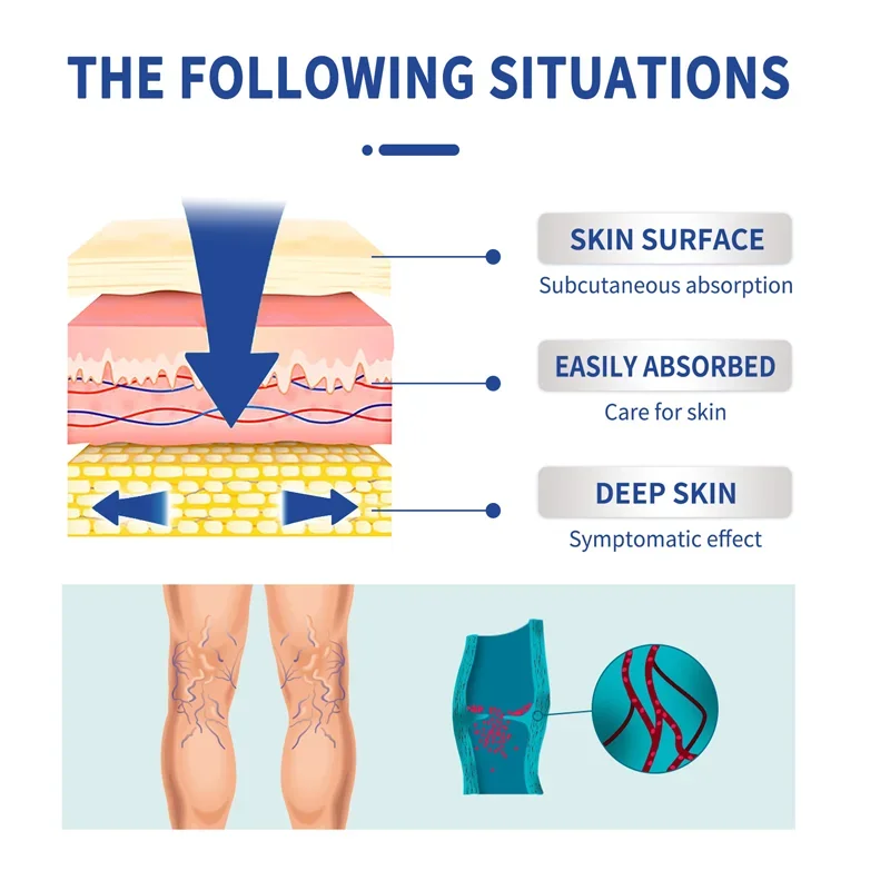 Laser Pen Lampshade Tool Varicose Veins Cream Remove Red Blood Streak Varicocele Vasculitis Phlebitis Strengthen Capillary