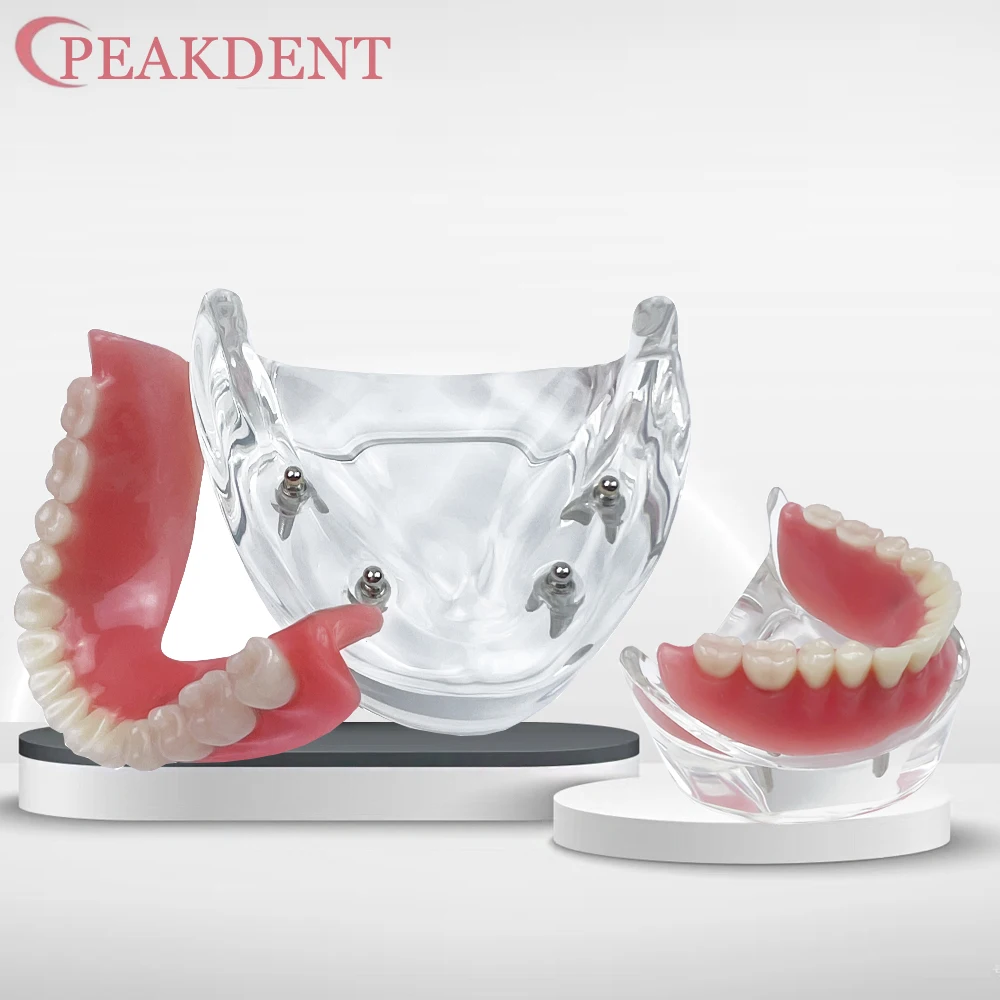 

1 шт., модель зубов для зубного имплантата, прозрачная модель нижней части челюсти, модель зубного протеза с 4 восстанавливающими винтами для медицинских исследований