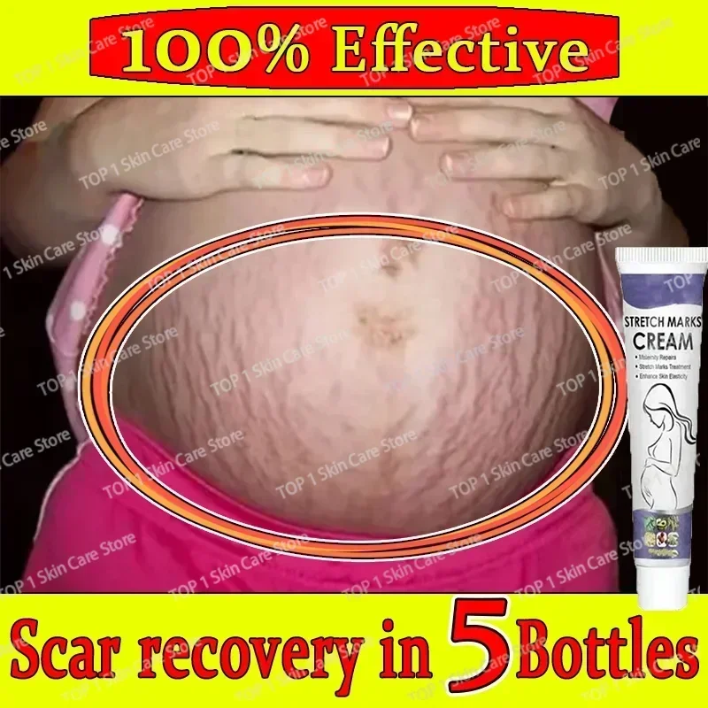 

Stretch Marks Remover Pregnancy Maternity Body New Old Stretch Remove Marks Lifting Firming Increase Elasticity Of Skin 1006