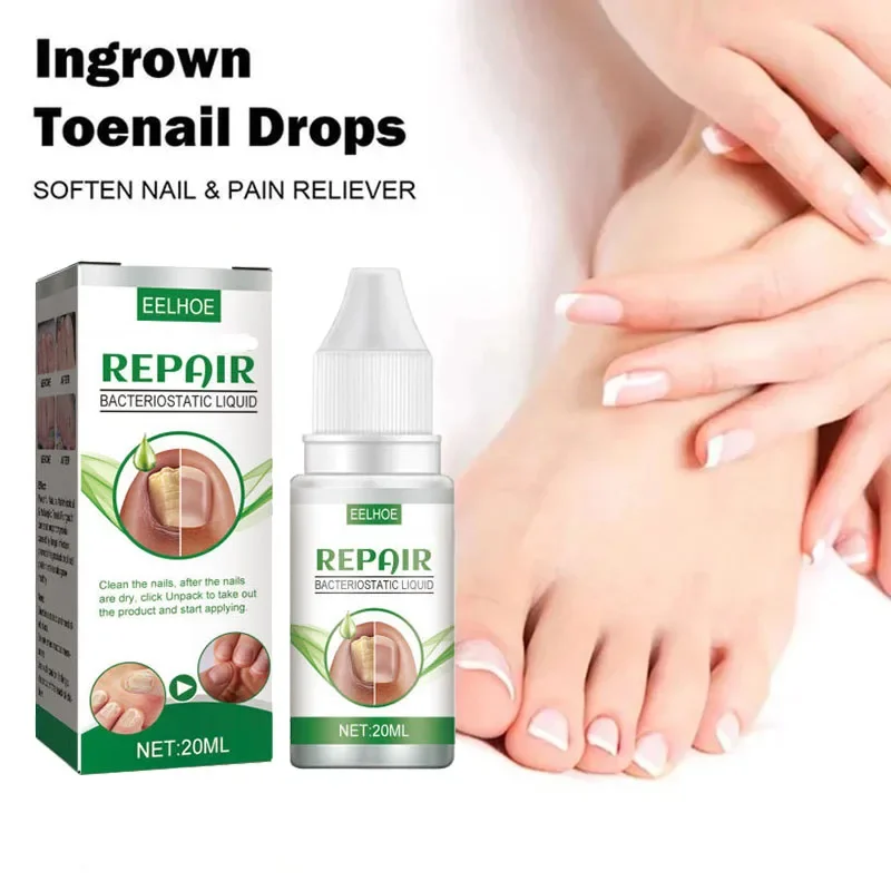 Nail 𝐅𝐮𝐧𝐠𝐮𝐬 𝐓𝐫𝐞𝐚𝐭𝐦𝐞𝐧𝐭 𝐎𝐧𝐲𝐜𝐡𝐨𝐦𝐲𝐜𝐨𝐬𝐢𝐬 𝐑𝐞𝐩𝐚𝐢𝐫 Herbaceous Essential oil For 𝐏𝐚𝐫𝐨𝐧𝐲𝐜𝐡𝐢𝐚