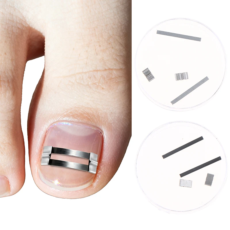 Ingrown Toenail Straightening Brace Tools Ingrown Toenail Corrector Clip Pedicure Recover Embed Toe Nail Treatment