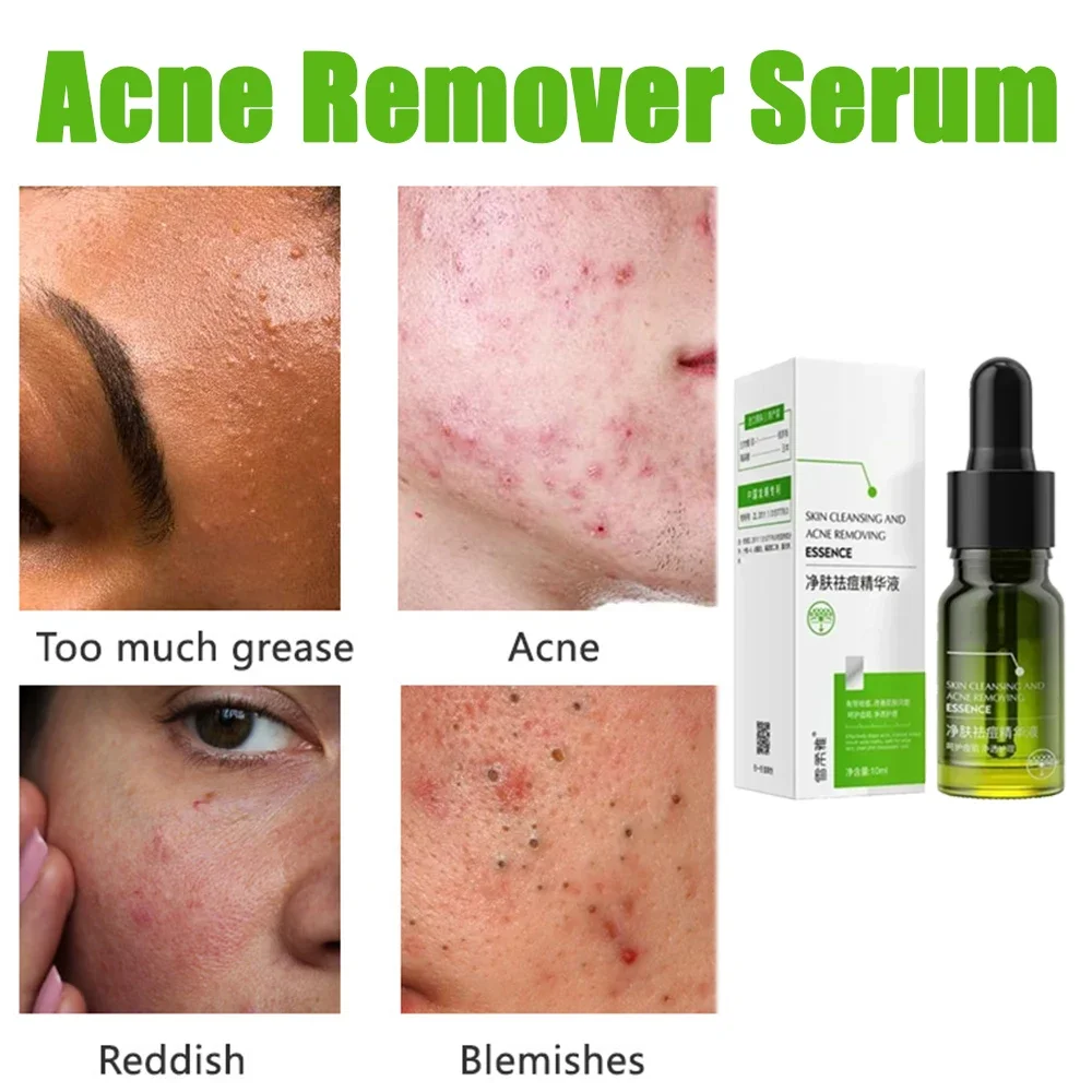 

Moisturizing Acne Remover Serum with Repairing Function for Shrink Pores and Oil Control Skin Care Essential