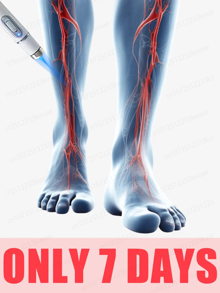 

Generation-2 Laser Says Goodbye To Spider Legs Varicose In 7 Days