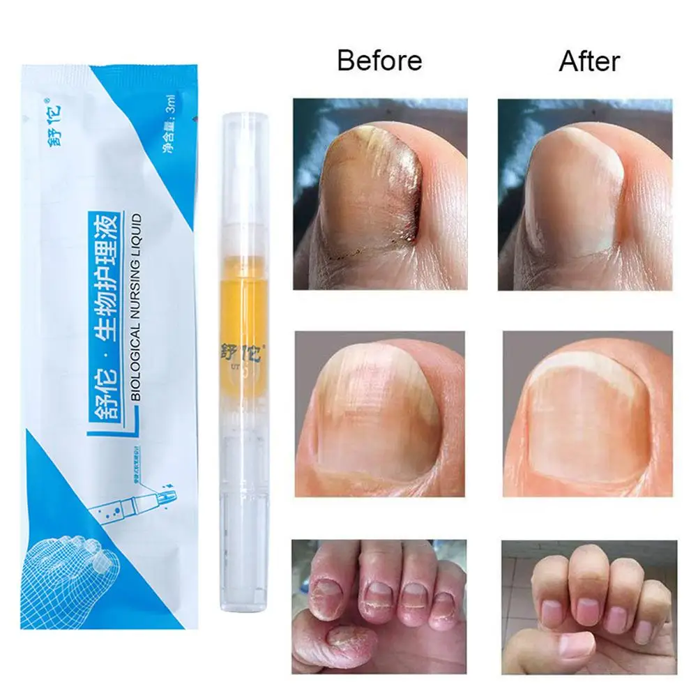 3ml Nail Treatment Solution Reusable Effective Nail Fungus Essence Lightweight Nail Nourishment Repair Pen Liquid For Women