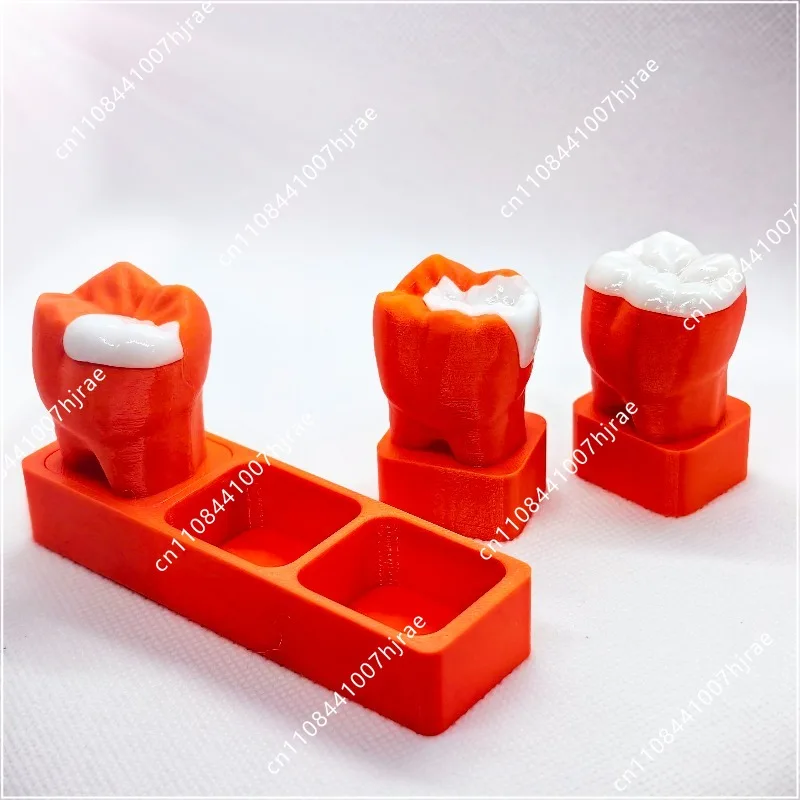 Inlay display model dental, high inlay, improve turnover rate communication model