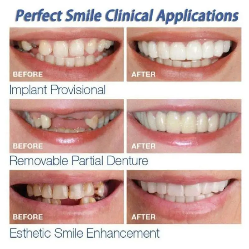 Teeth Cover Veneers Whitening Dentures Imitation Braces Temporary False Teeth Cover Perfect Smile Comfortable Fit Denture Kit