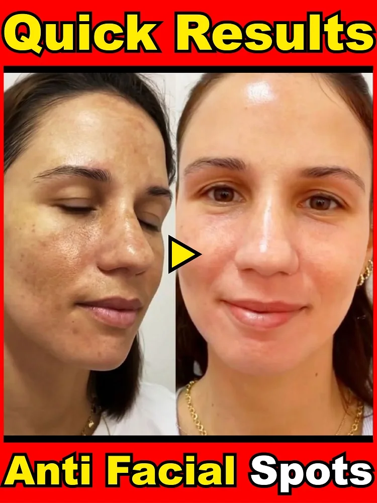 

Solve all pigmentation symptoms and facial dark spots, 100% effective