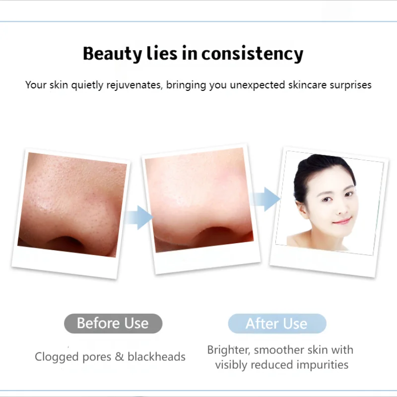 Ultrasone huidscrubber gezichtsreinigingsapparaat voor het verwijderen van mee-eters en huidafschilfering, schoonheidstool voor thuisgebruik (niet-medisch)