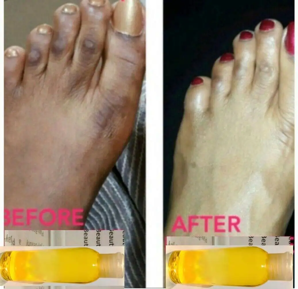 

Fast DARK KNUCKLES , DARK FEET & KNEE SOLUTION ORIGINAL YELLOW PEELING OIL Skin Care