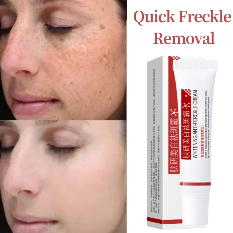 

Lightening Freckle Cream Remove Dark Spot Cream Anti Freckle and Aging Cream Fade Pigmentation Melasma Brighten Serum Skin Care