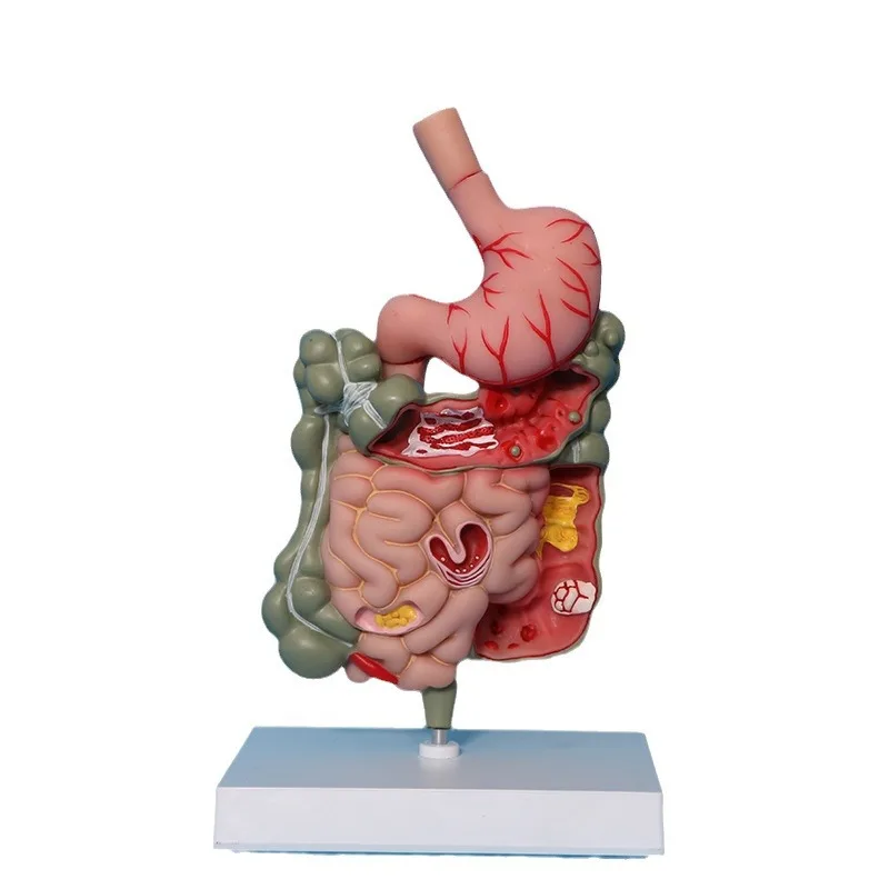 

Production of gastric anatomy, large intestine, cecum, rectum human digestive system lesion model