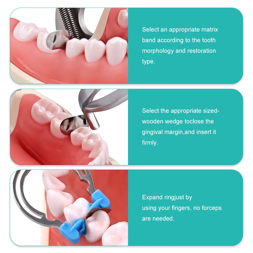 Denspay Dental Sectional Contoured Metal Spring Clip Metal Spring Clip Rings Dentist Matrix Ring Tools Dental Lab Instrument