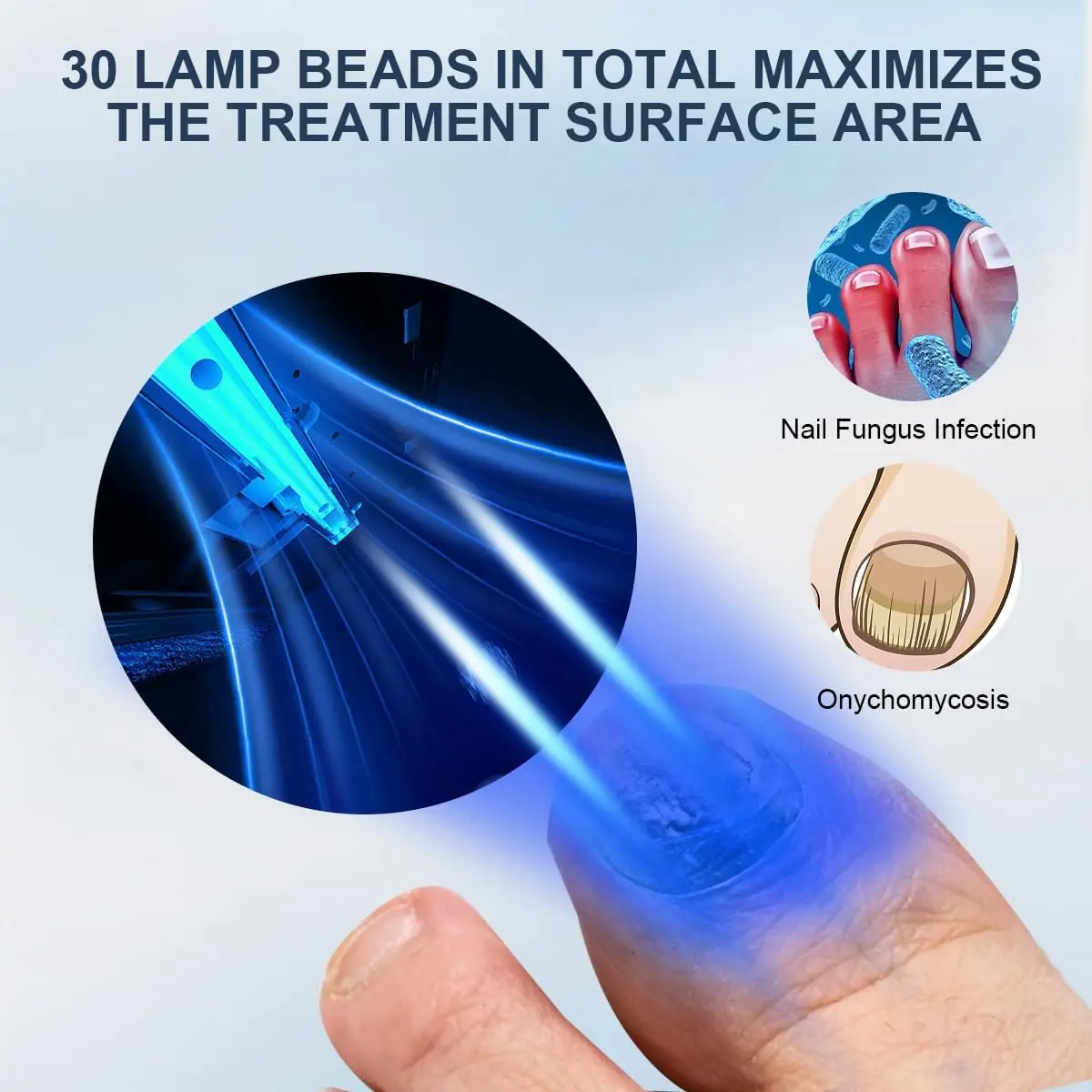 Appareil de réparation laser pour champignon des ongles, champignon des ongles, onychomycose anxieuse, anti-infection, paronyfriend incarné, N64.