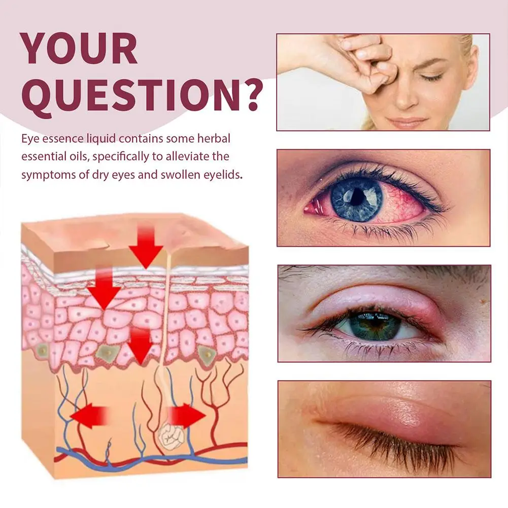 Esencia para aliviar la hinchazón de los ojos, alivia la fatiga ocular, elimina los gránulos de grasa, mejora el enrojecimiento, Stye, tratamiento ocular, hidrata el suero ocular